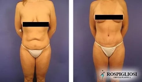 ¿Cuánto peso necesito perder antes de una abdominoplastía?