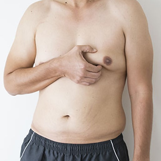 serv-ginecomastia-min