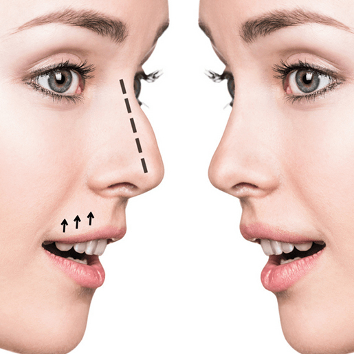 serv-rinoplastia